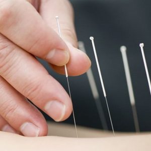 Triggerpunkttherapie / Dry Needling
